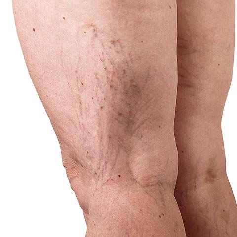 capillari rotti sulle gambe
